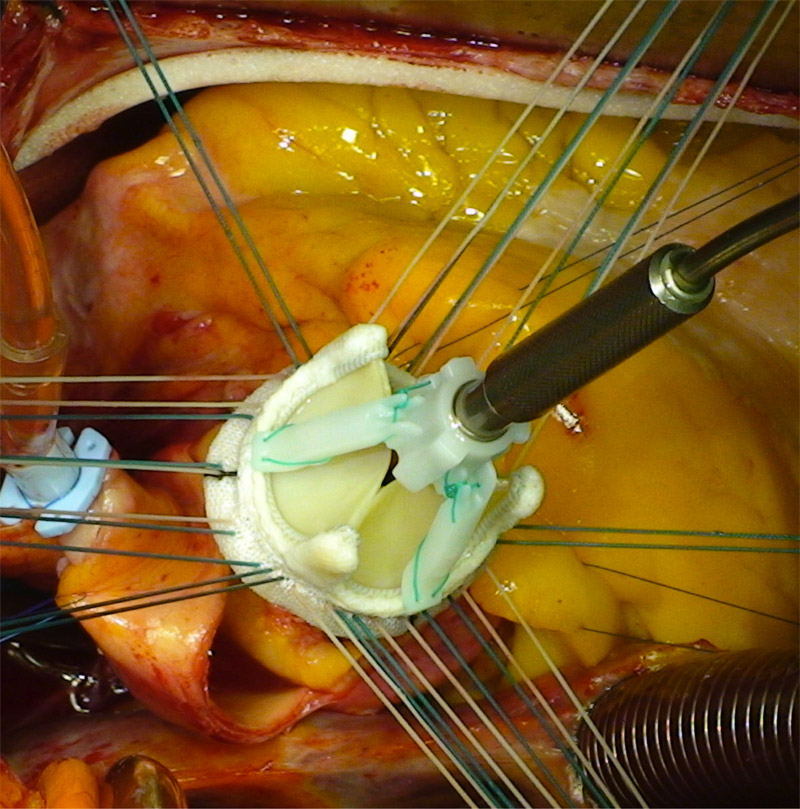 Malformation de la valve aortique : un mécanisme dévoilé · Inserm, La  science pour la santé